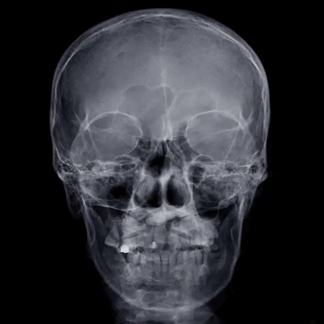 X-RAY SKULL AP  VIEW