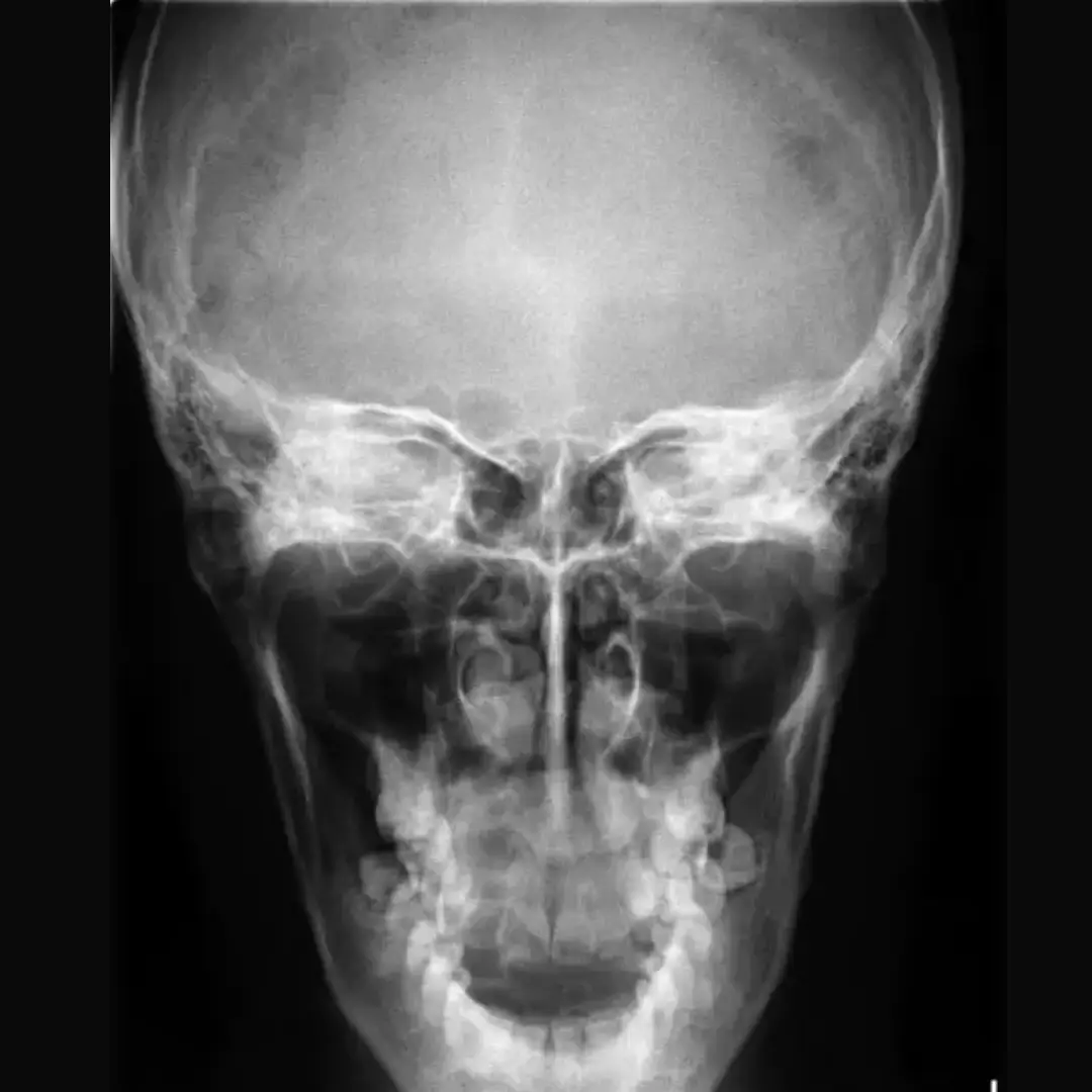 X-RAY REVERSE TOWNE VIEW