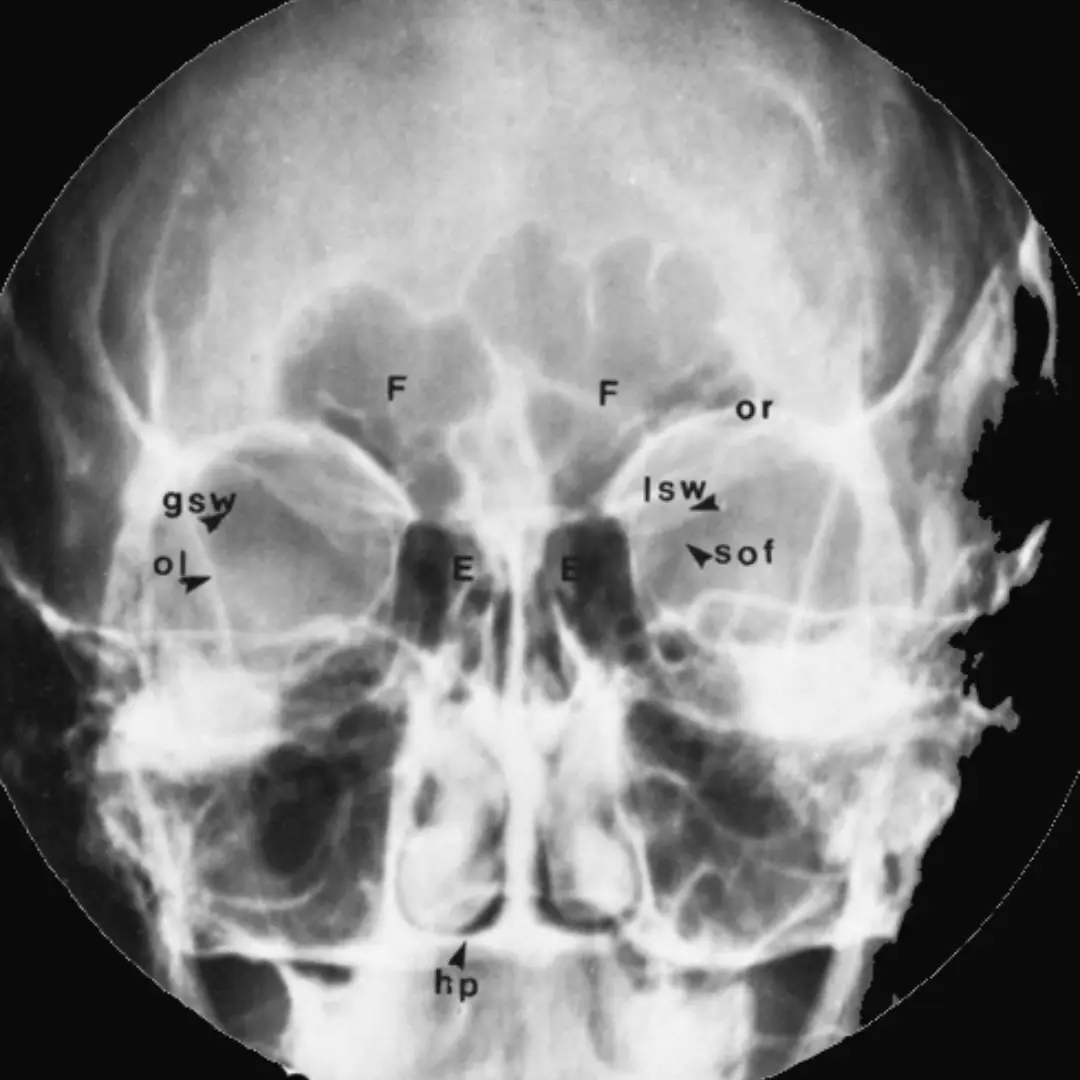 X-RAY PARANASAL SINUS LAT VIEW