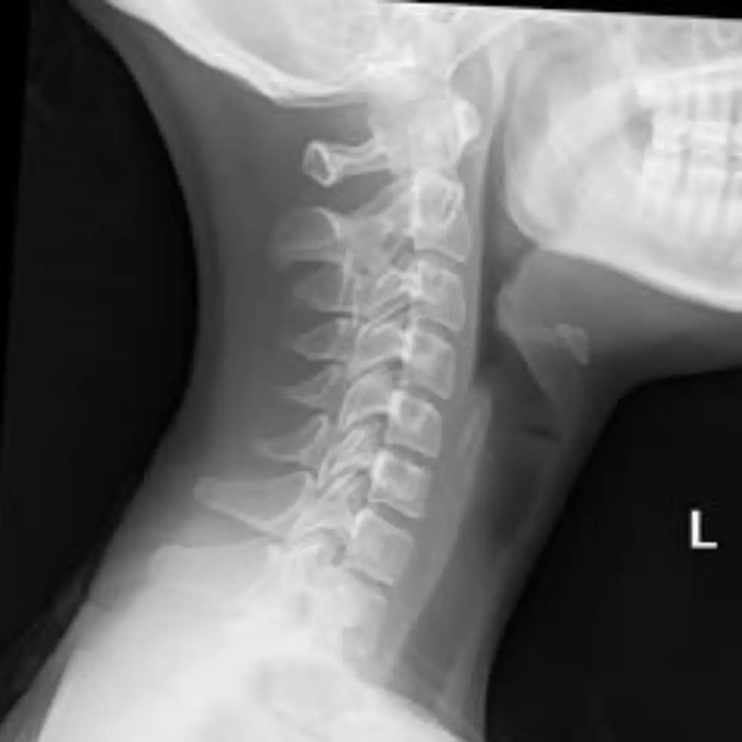 X-RAY SOFT TISSUE NASOPHARYNGEAL JOINT LAT VIEW