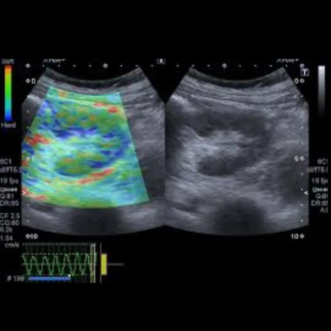 USG ELASTOGRAPHY