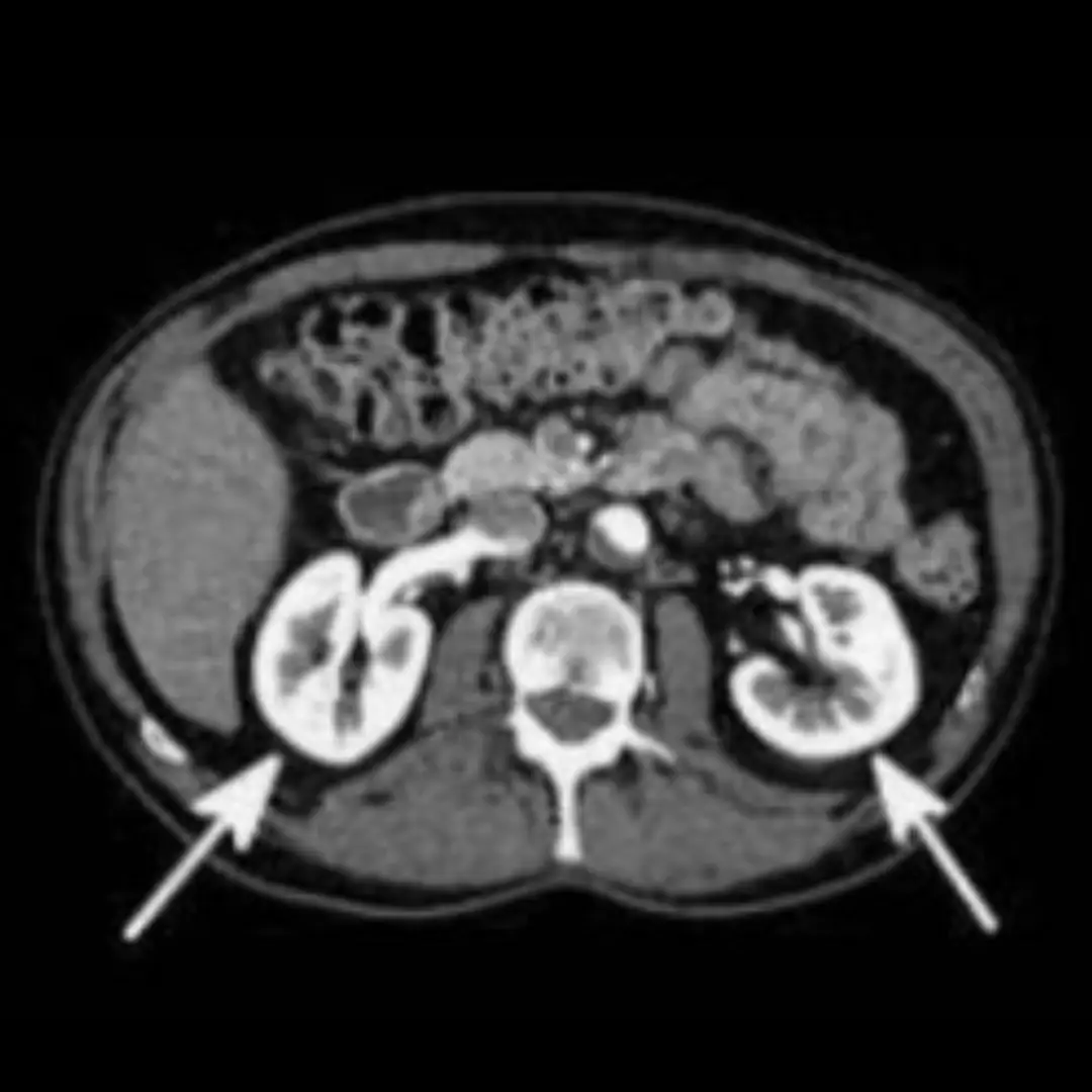 NCCT UPPER ABDOMEN (PLAIN)