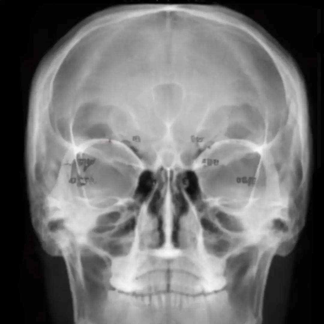 X-RAY PARANASAL SINUS CORONAL VIEW