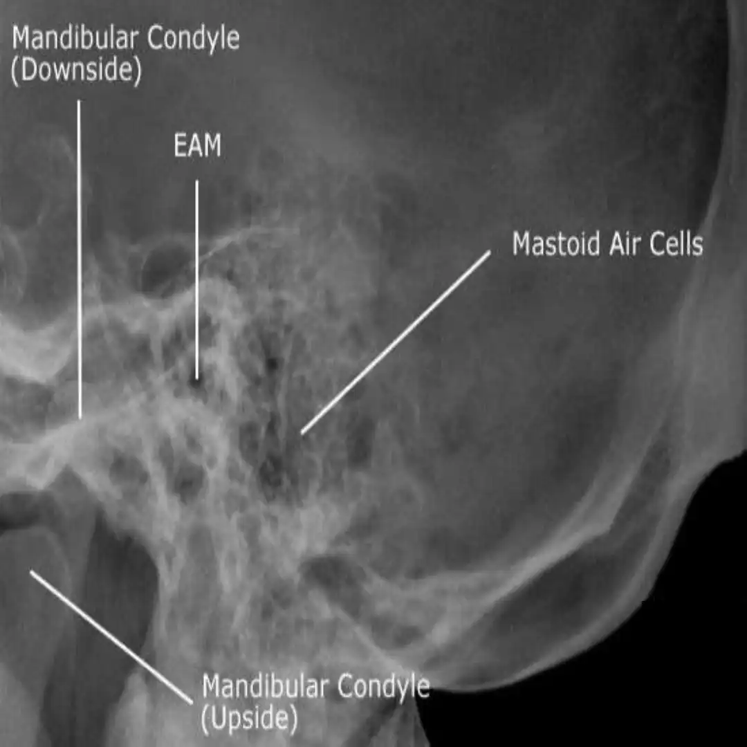 X-RAY MASTOID LAT VIEW
