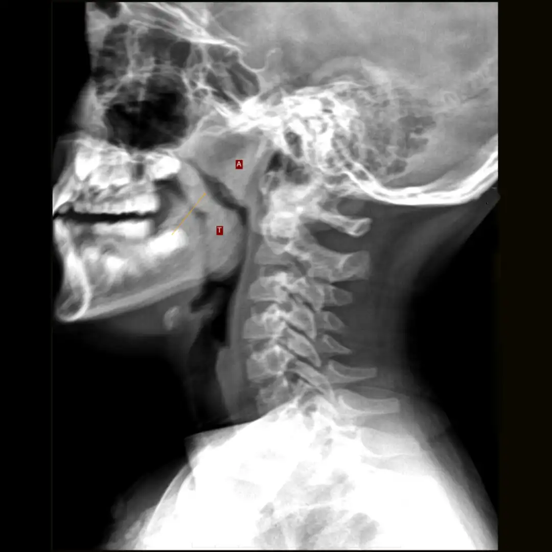 X-RAY ADENOID HYPERTROPHY LAT VIEW