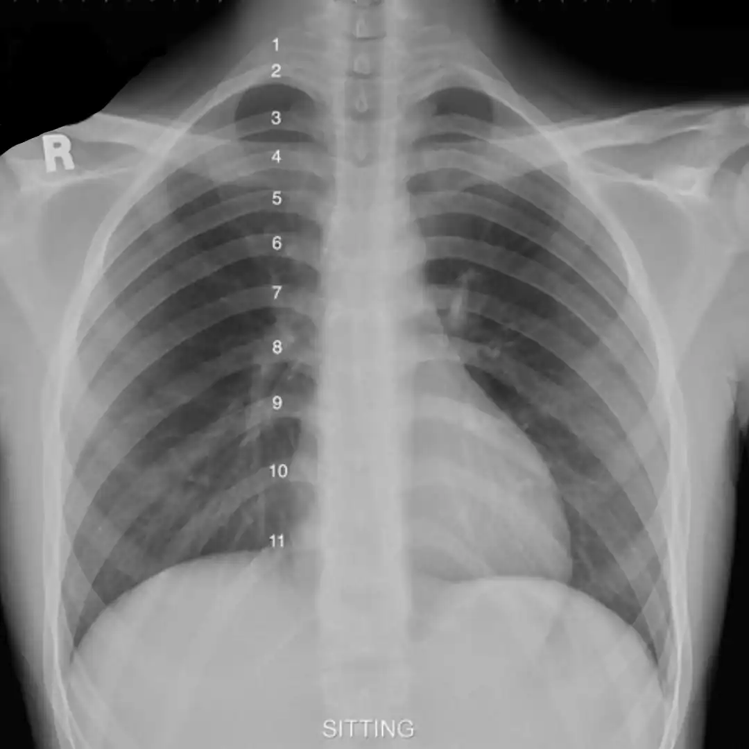 X-RAY CHEST PA VIEW