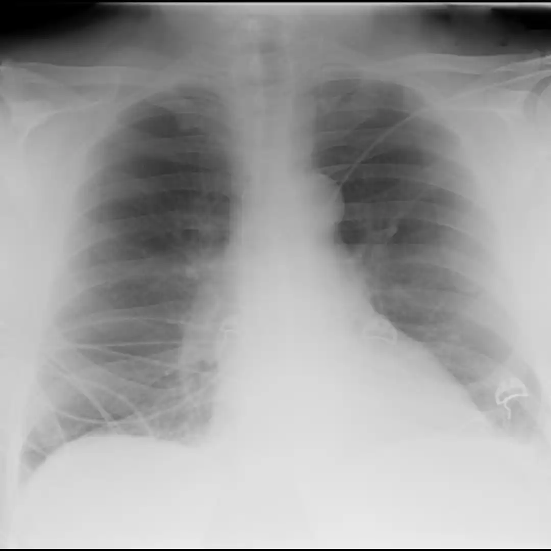 X-RAY CHEST AP VIEW