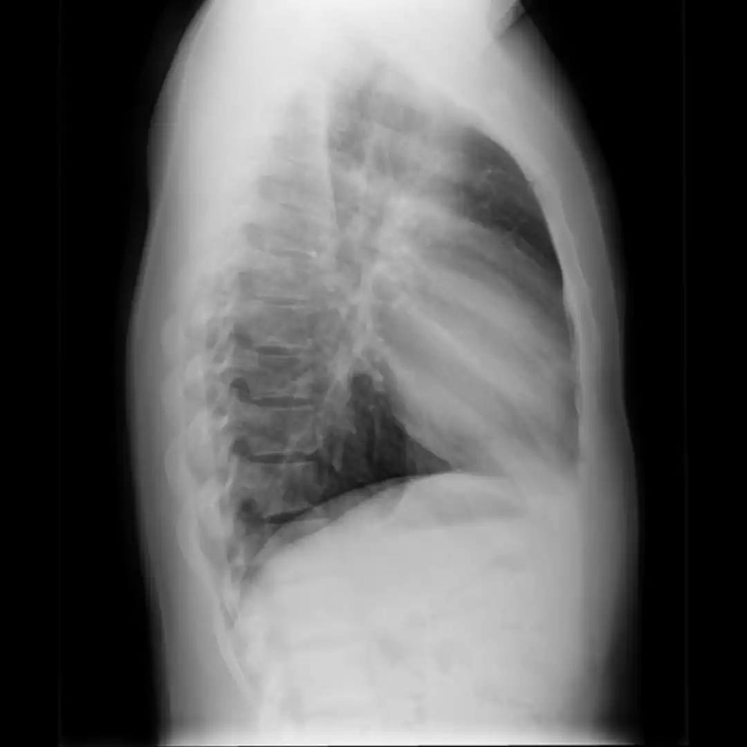 X-RAY CHEST LATERAL VIEW