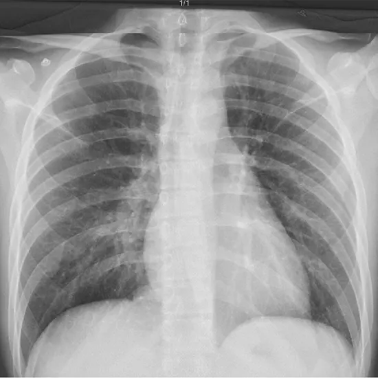 X-RAY CHEST OBLIQUE VIEW