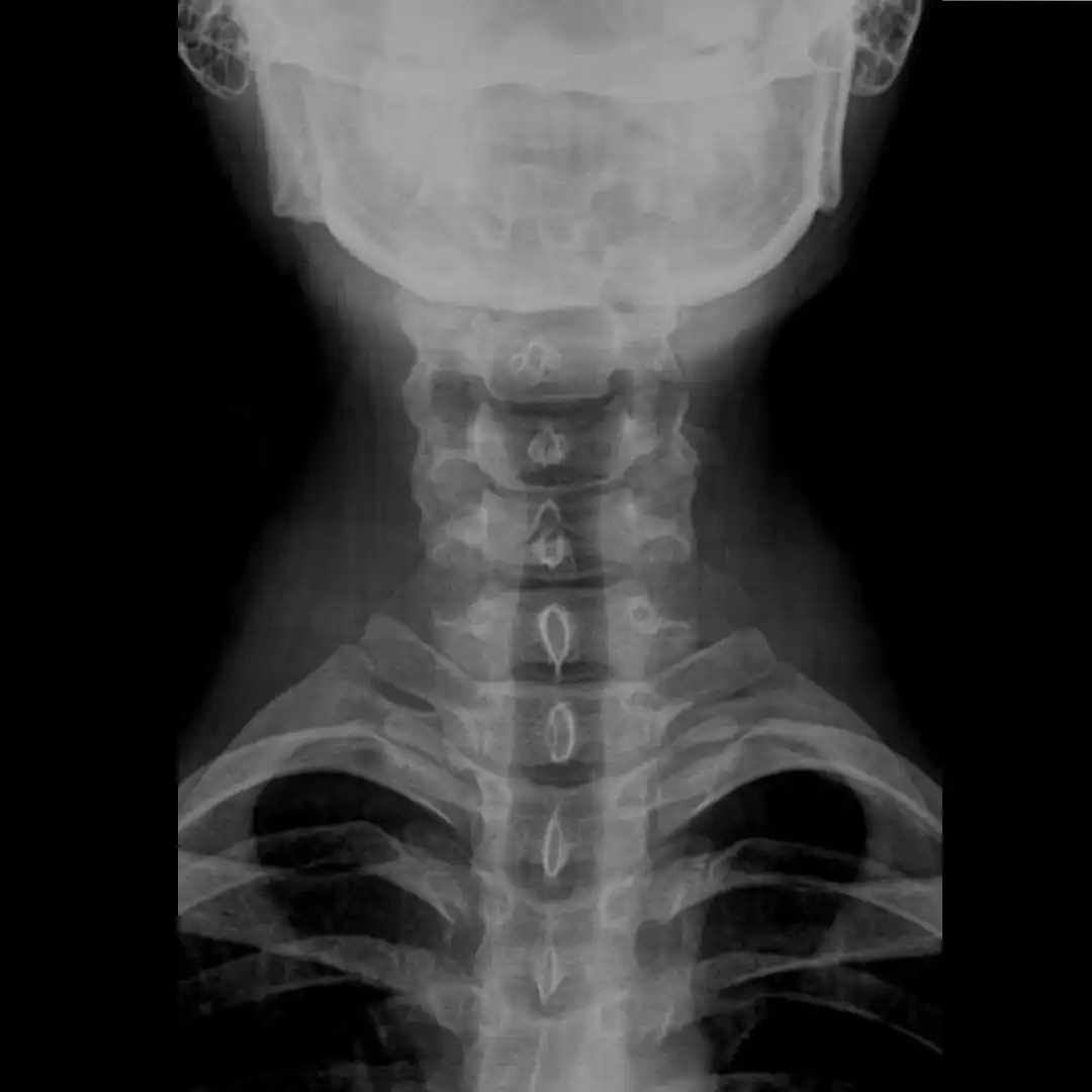 X-RAY CERVICAL SPINE AP VIEW