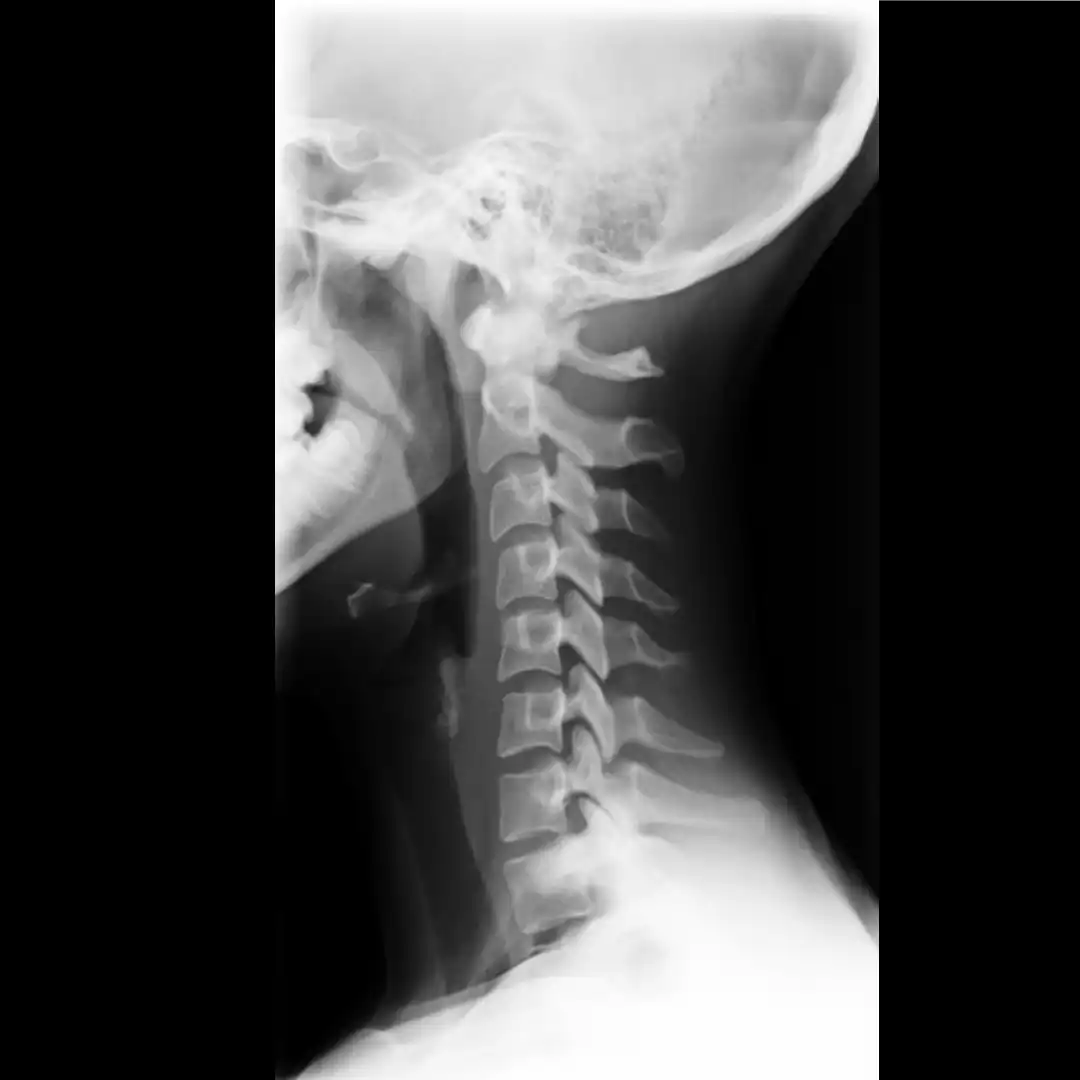 X-RAY CERVICAL SPINE LAT VIEW