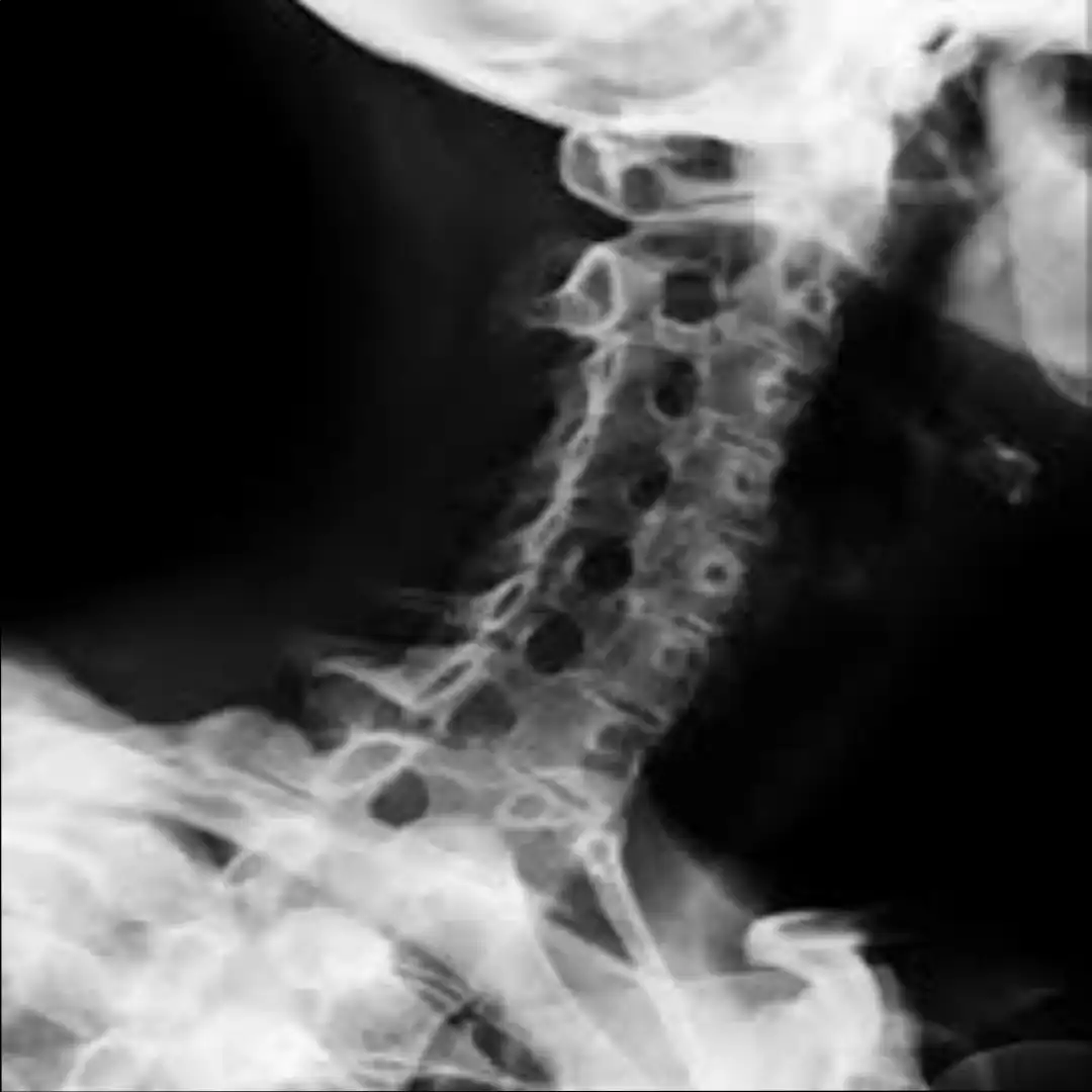 X-RAY CERVICAL SPINE OBLIQUE VIEW
