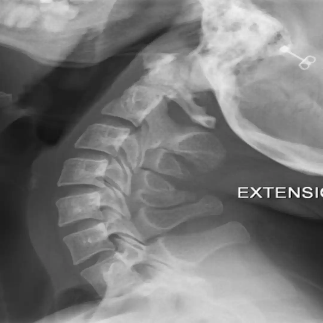 X-RAY CERVICAL SPINE EXTENSION VIEW