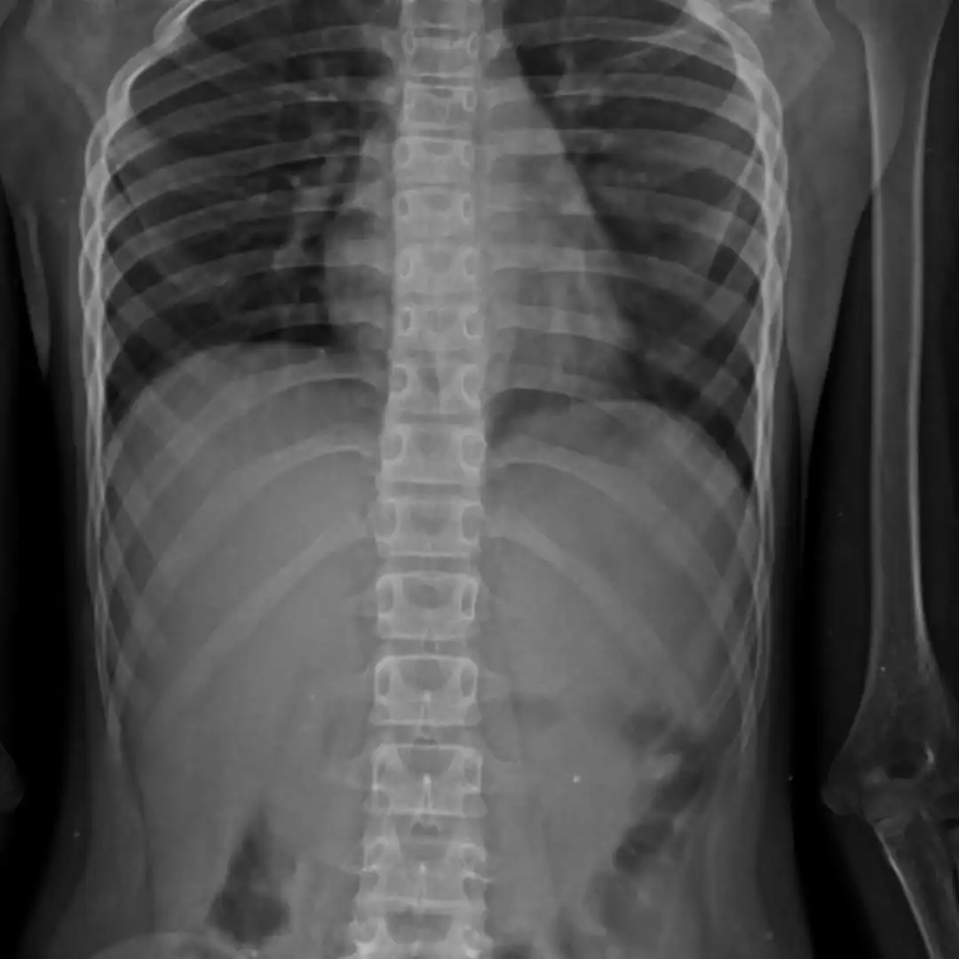 X-RAY DORSAL SPINE AP VIEW