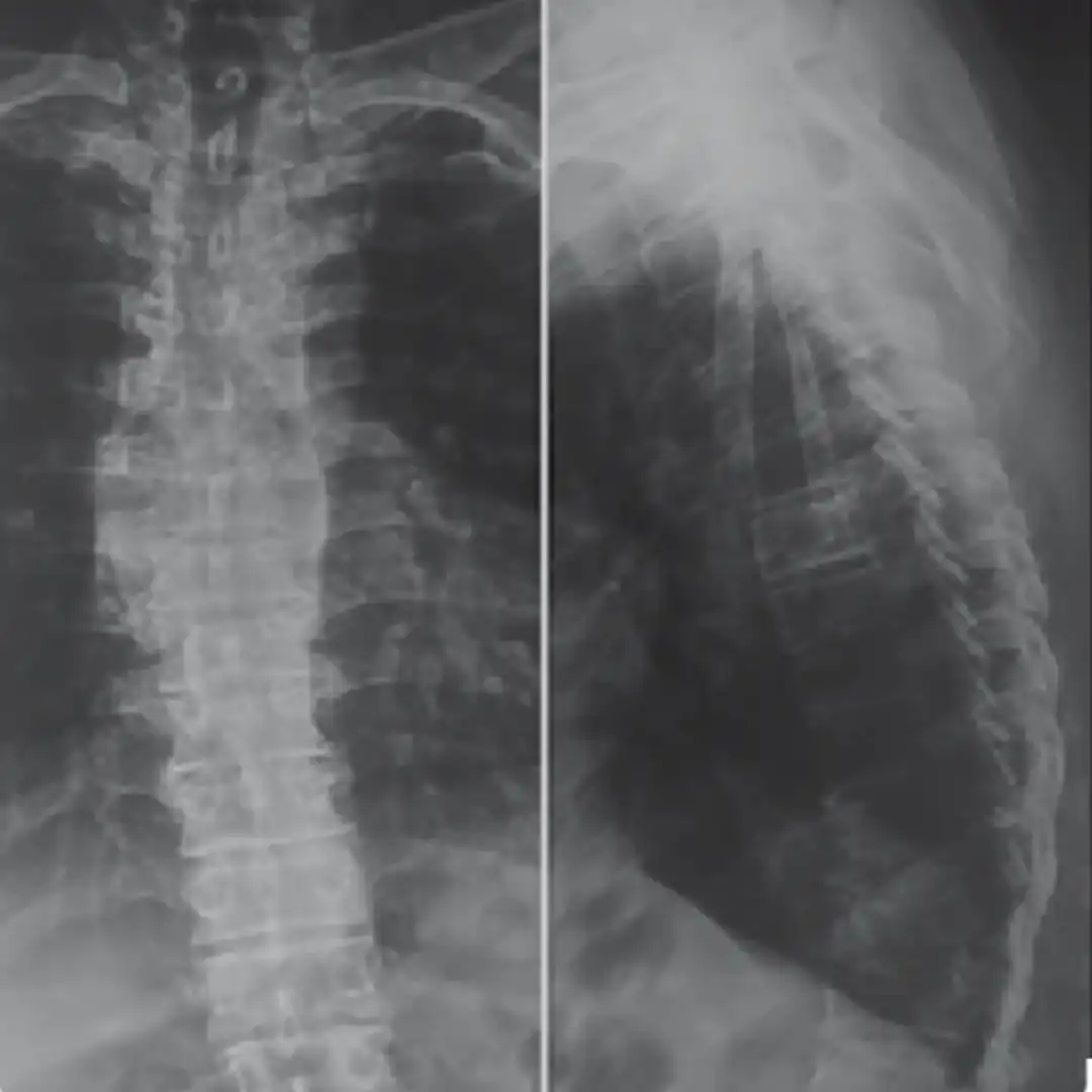 X-RAY DORSAL SPINE LAT