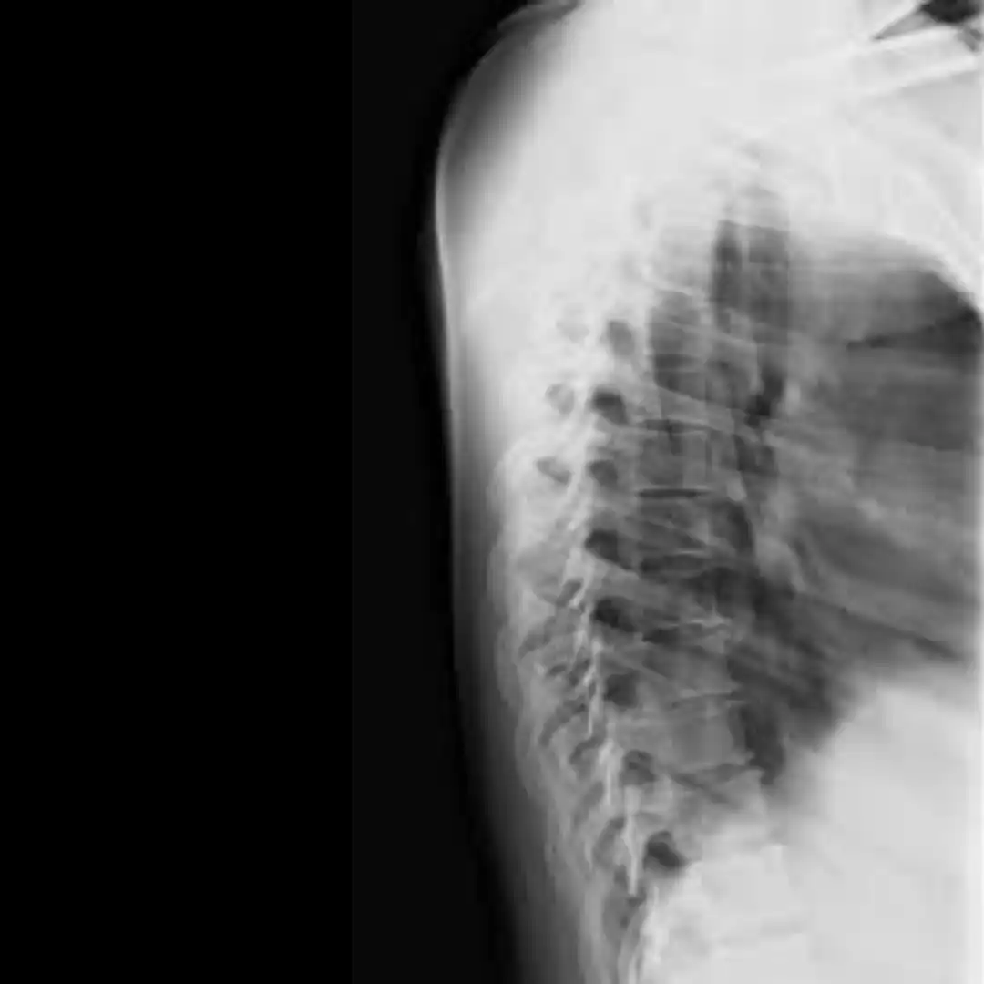 X-RAY DORSAL SPINE OBLIQUE VIEW