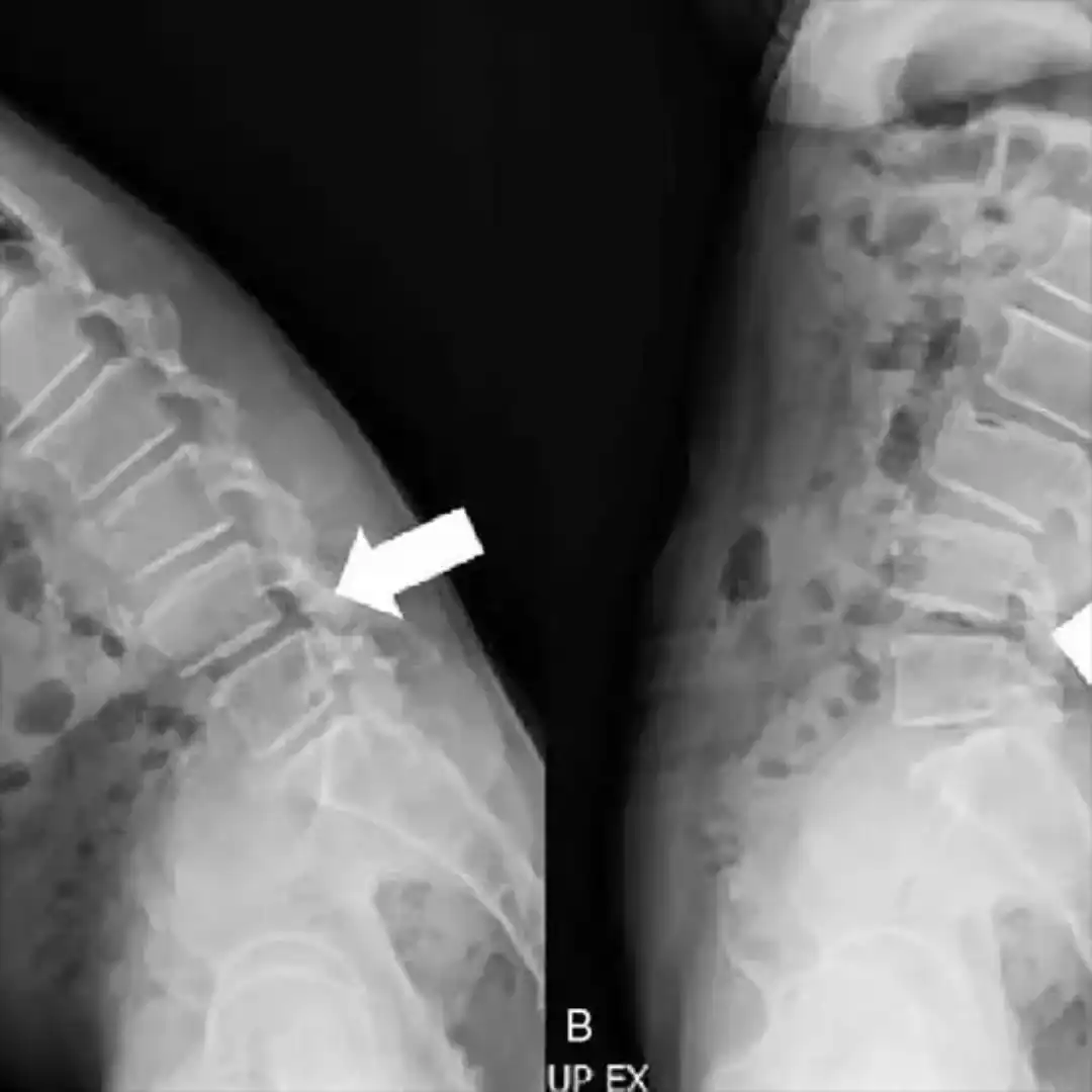 X-RAY DORSAL SPINE EXTENSION VIEW
