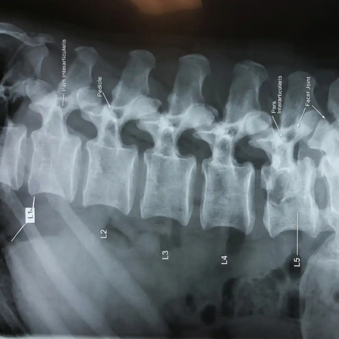 X-RAY LUMBAR SPINE OBLIQUE