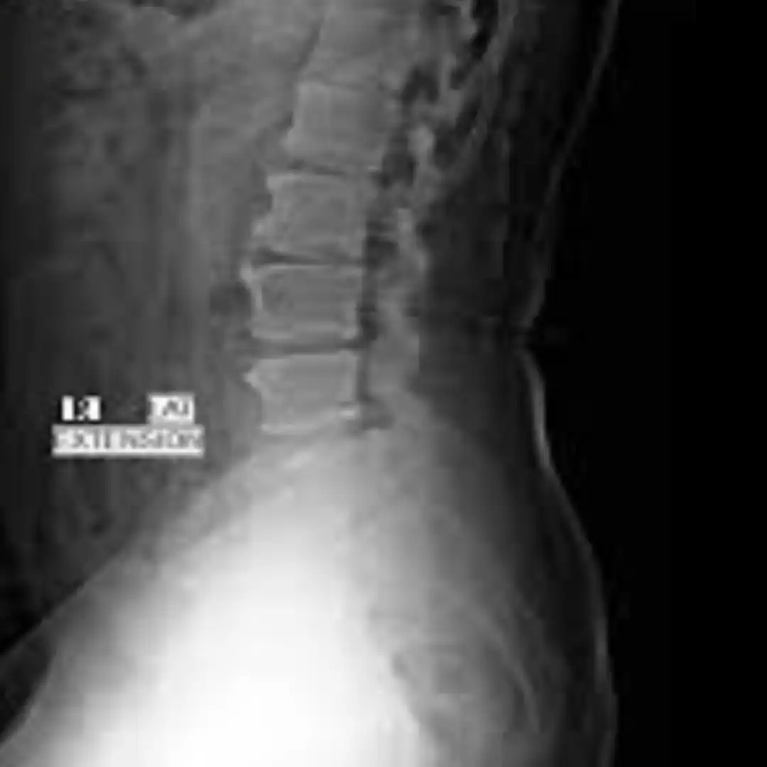 X-RAY LUMBAR SPINE EXTENSION