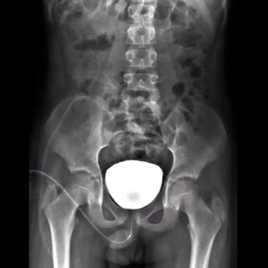 X-RAY MCU  Micturating Cysto Urethrogram
