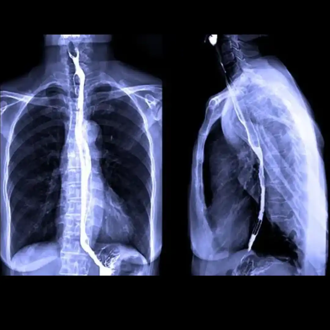 X-RAY BARIUM SWALLOW