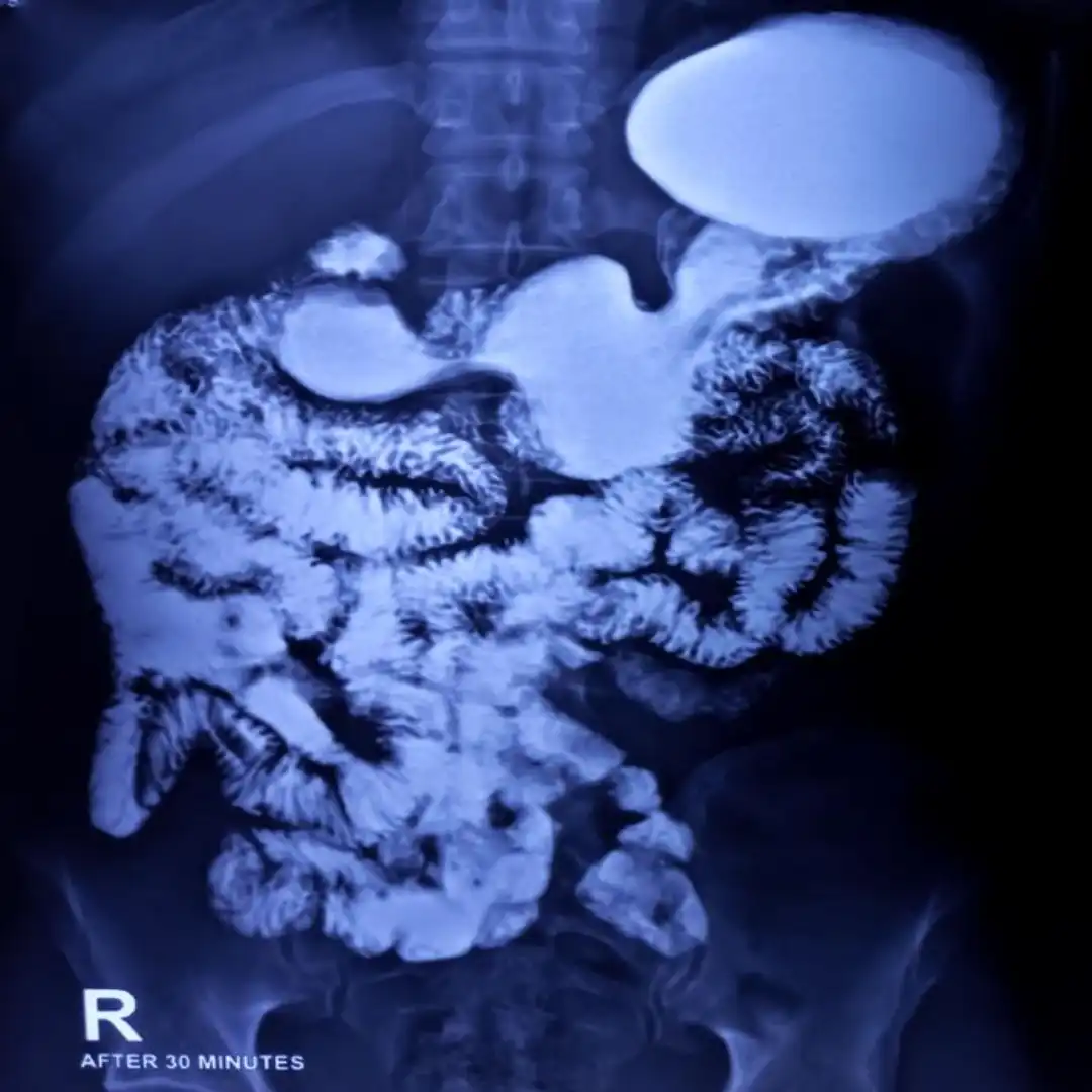 X-RAY BARIUM MEAL FOLLOW THROUGH