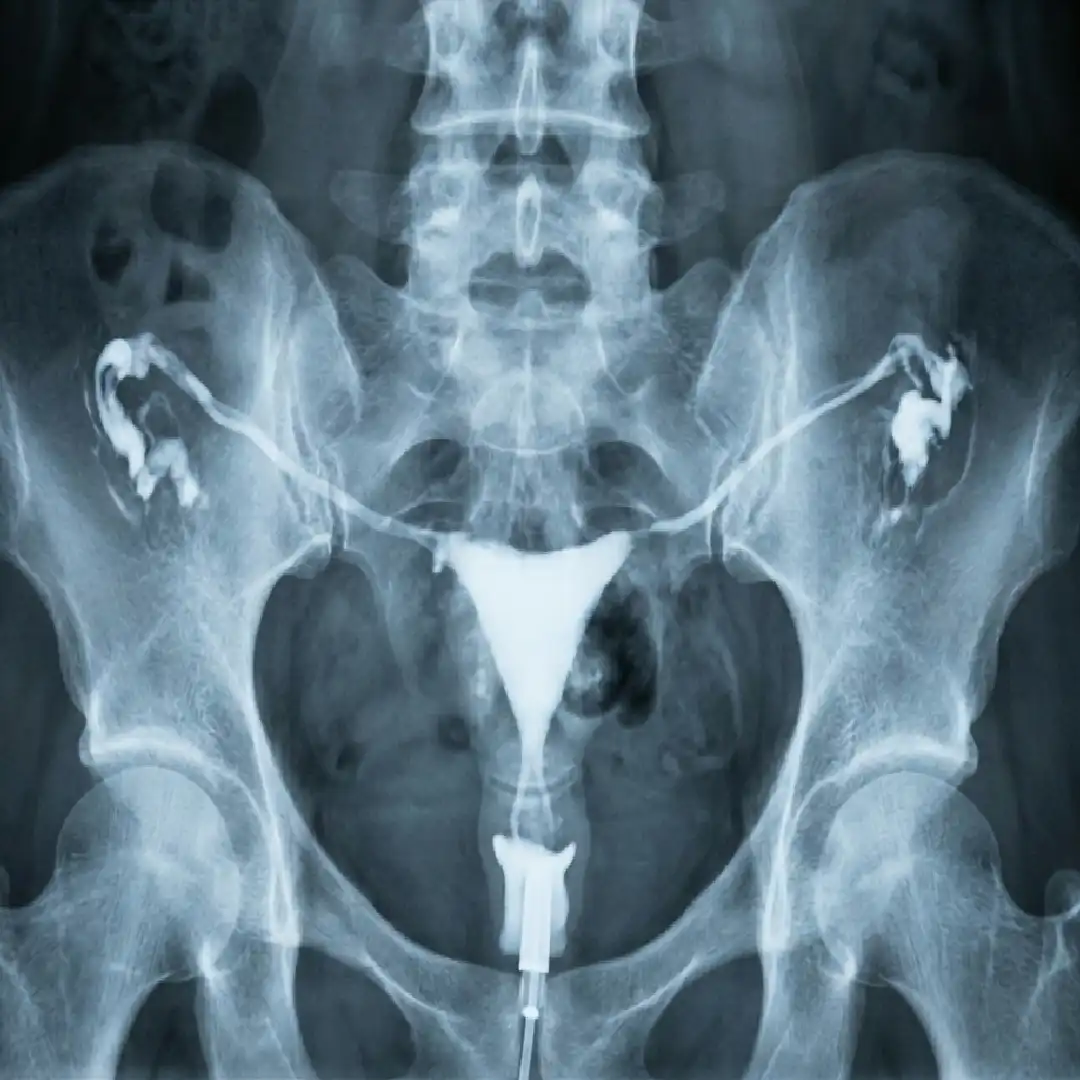 X-RAY HSG- HYSTEROSALPINGOGRAM PROCEDURE