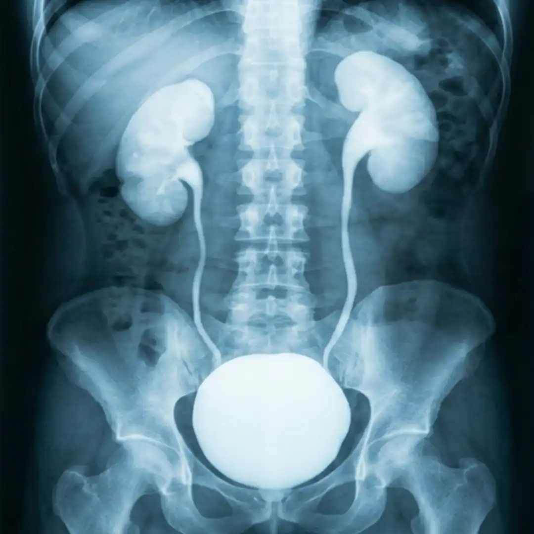 X-RAY I.V.P  Intravenous Pyelogram