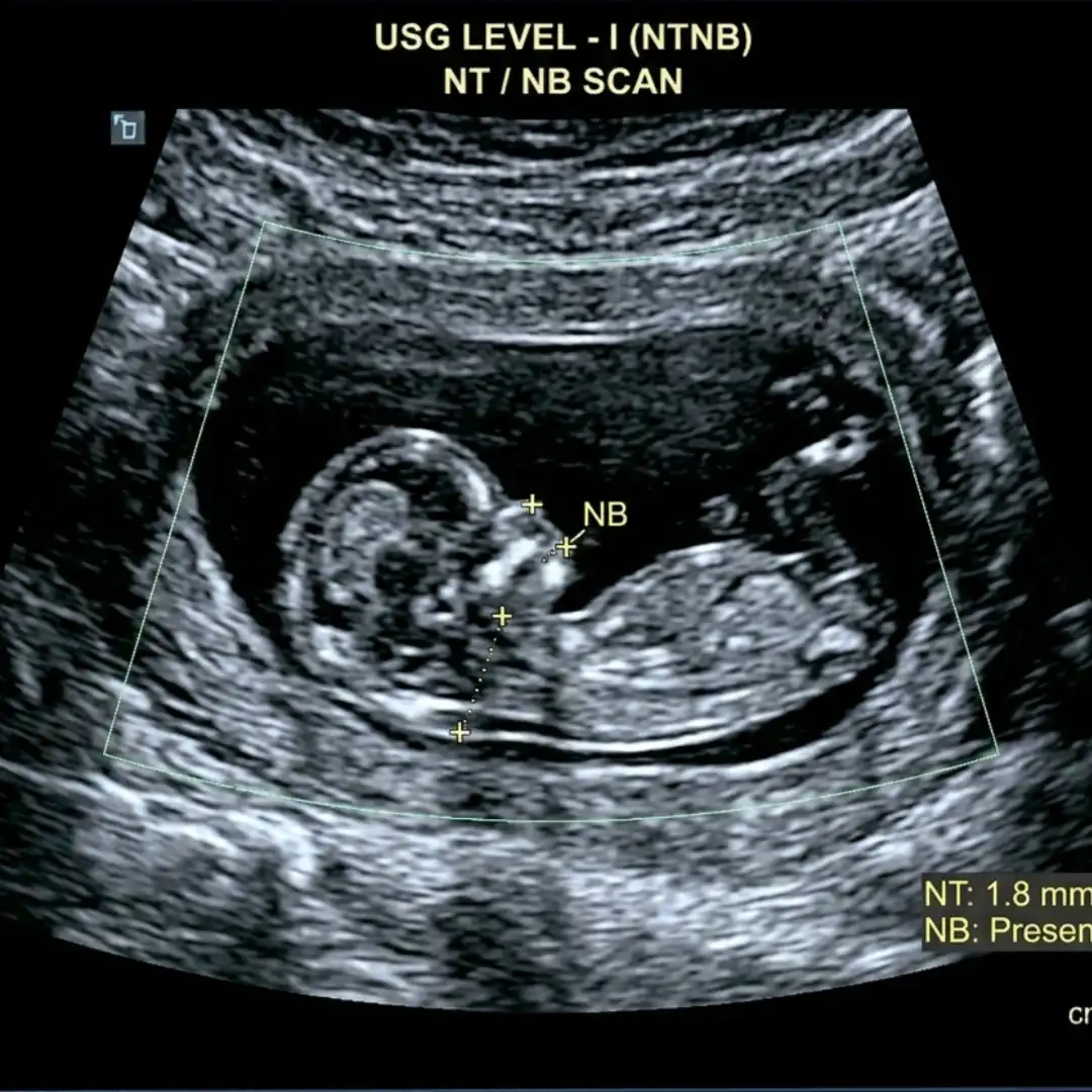 USG LEVEL - I (NTNB)