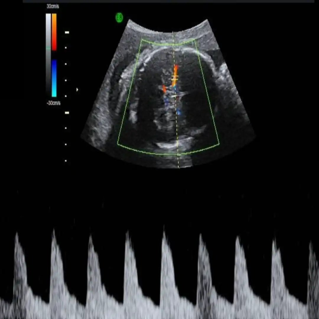 USG OBSTETRIC DOPPLER