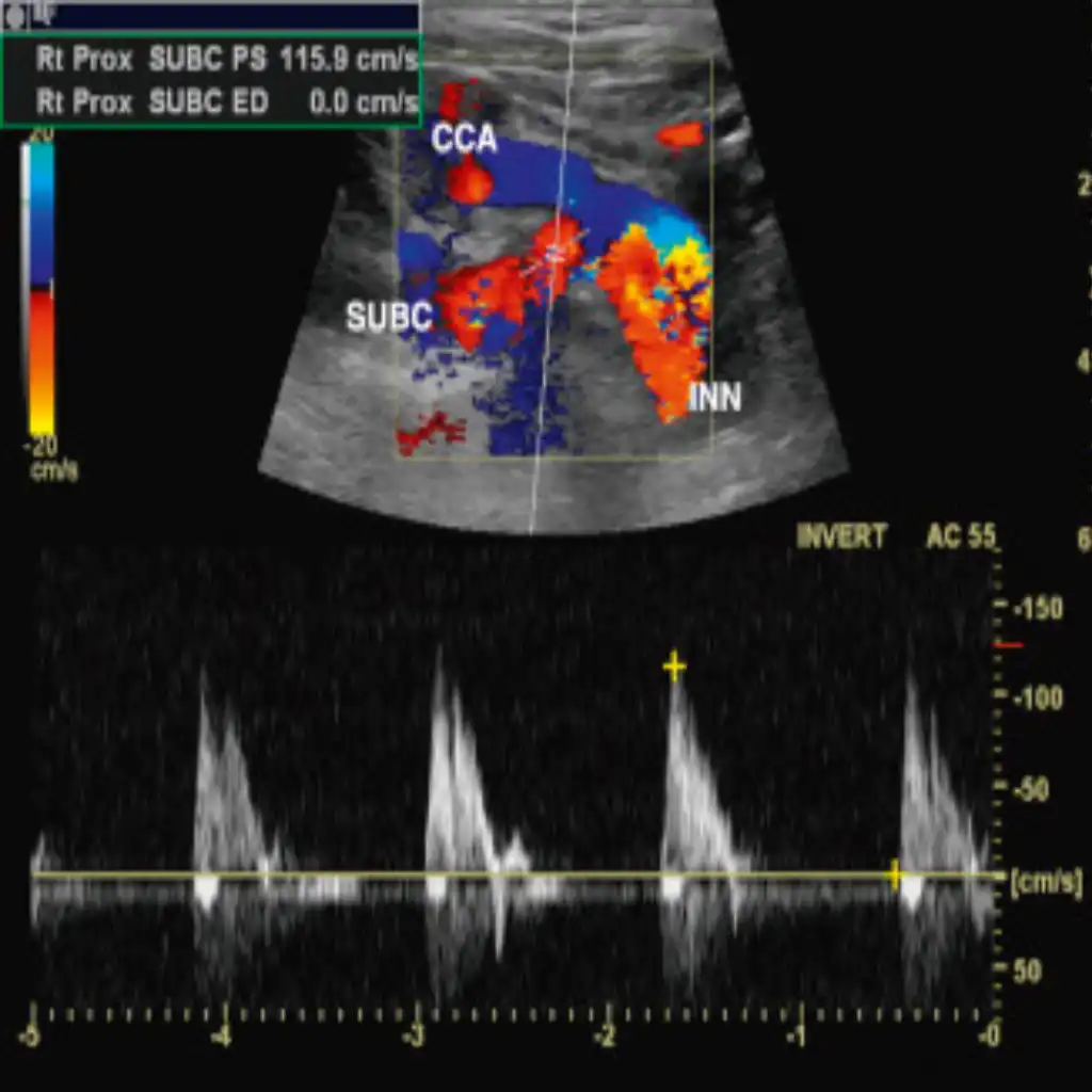 USG BOTH UPPER LIMB ARTERIAL DOPPLER