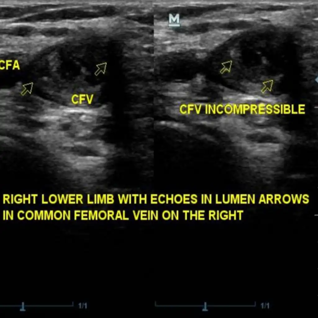 USG SINGLE LOWER LIMB VENOUS DOPPLER