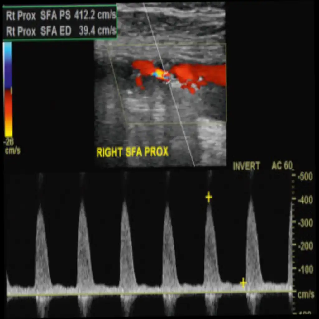 USG BOTH LOWER LIMB ARTERIAL DOPPLER