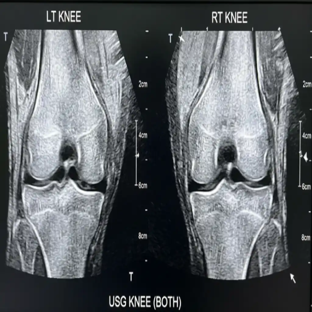 USG KNEE (BOTH)
