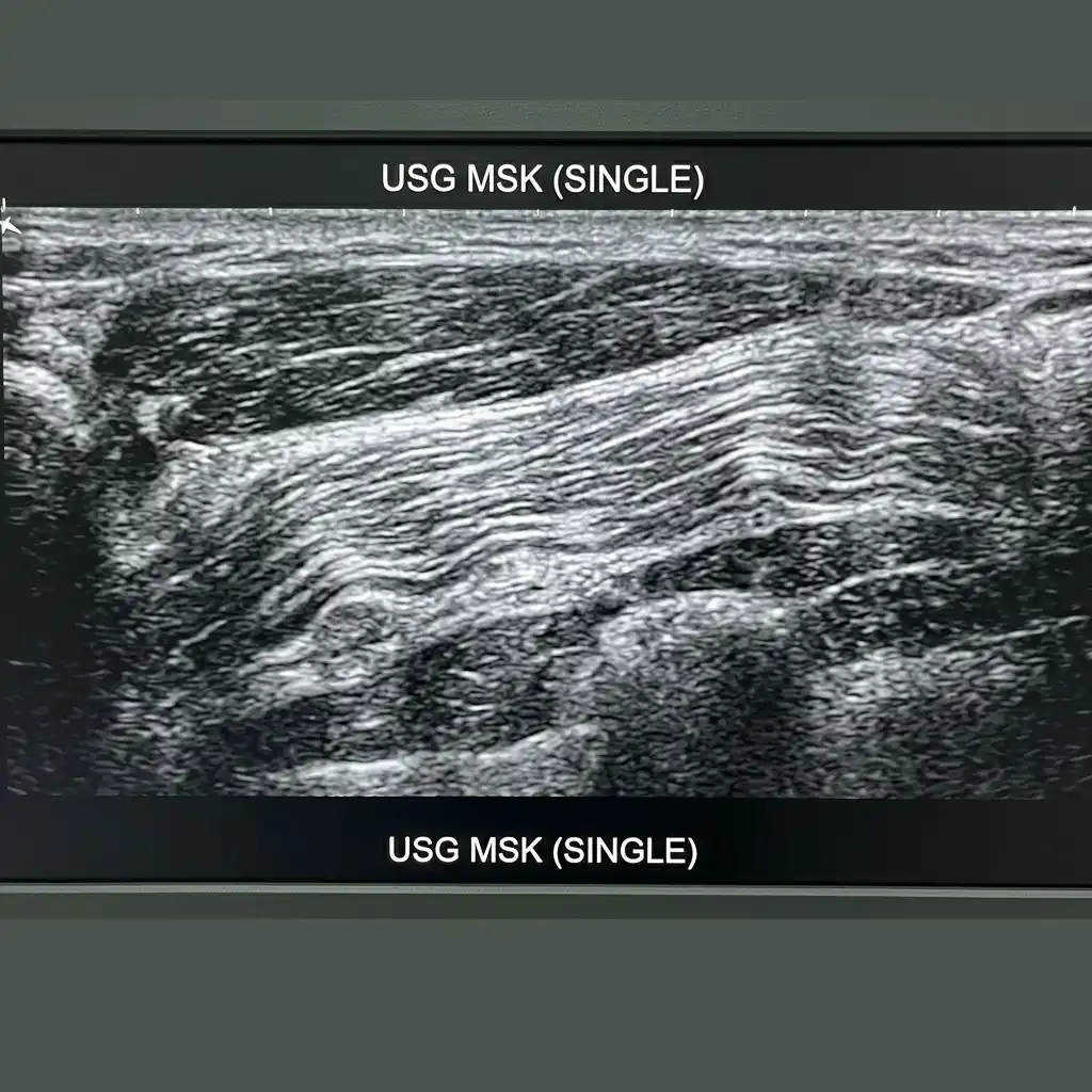 USG KNEE (SINGLE)