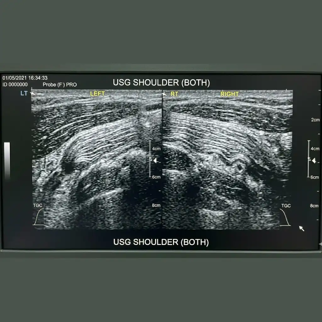 USG SHOULDER (BOTH)