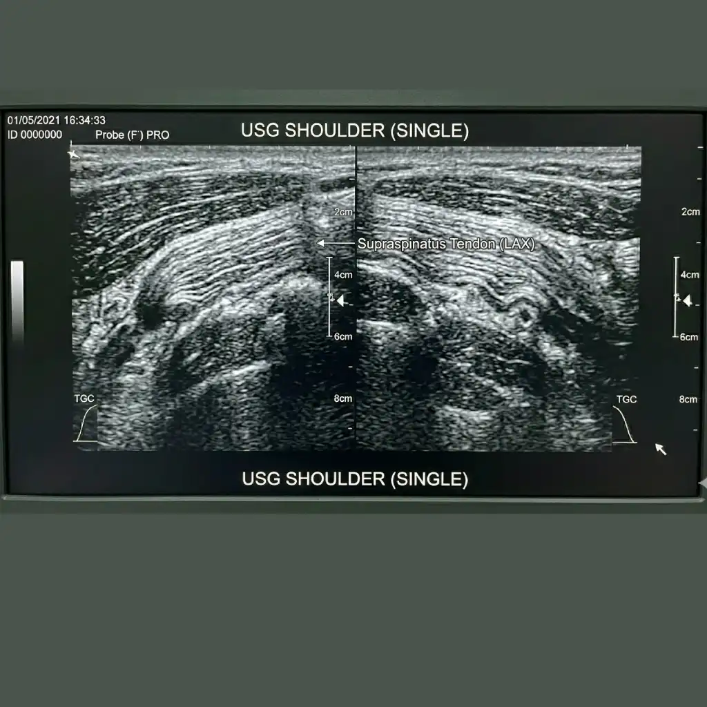 USG SHOULDER (SINGLE)