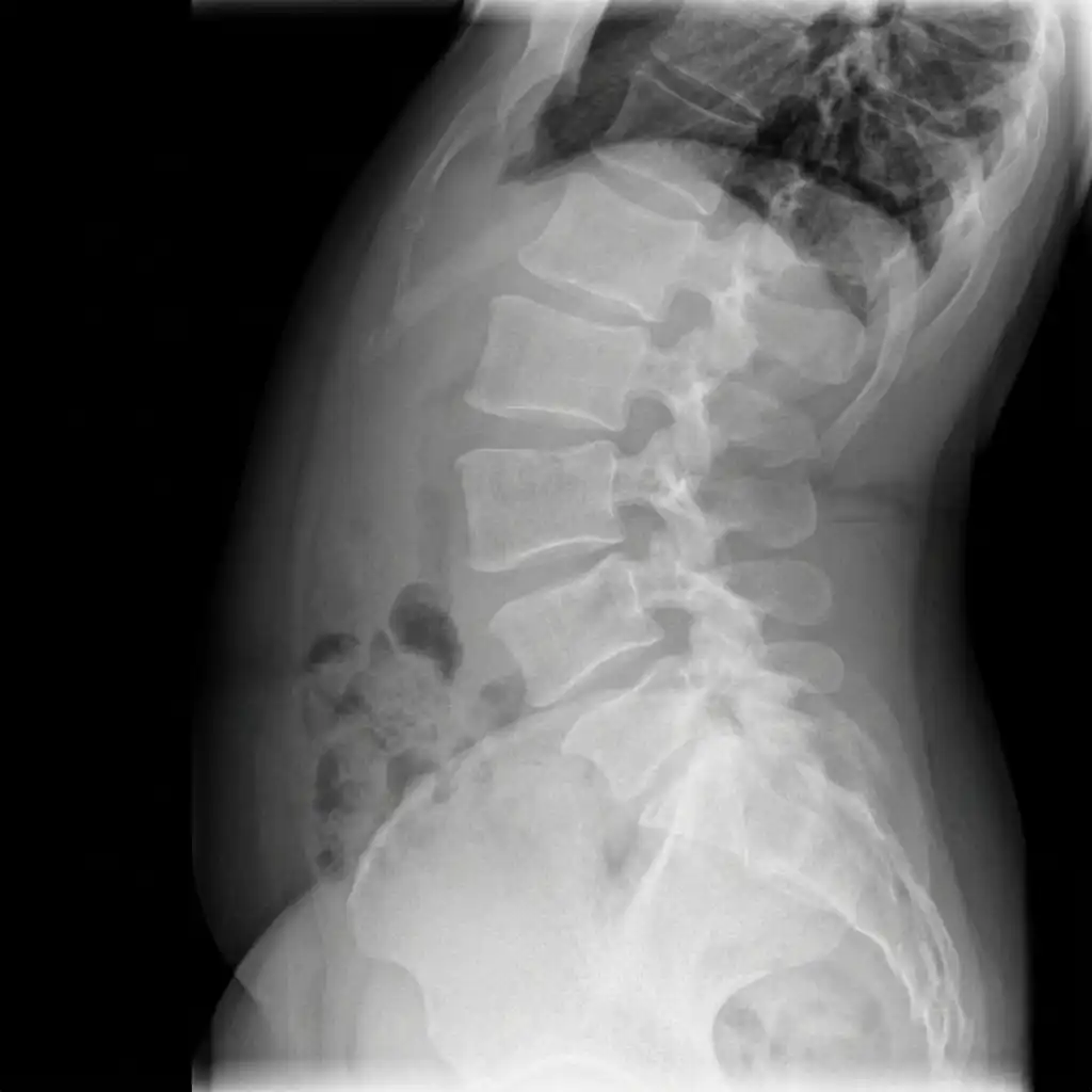 X RAY LUMBAR SPINE FLEXION