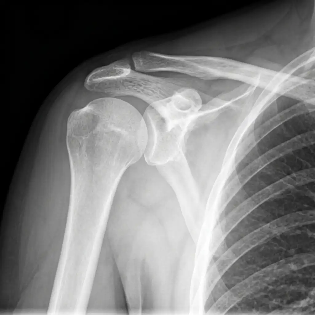 X RAY SHOULDER AP VIEW