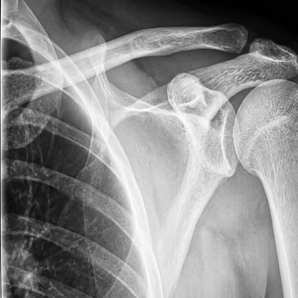X RAY SHOULDER Y VIEW